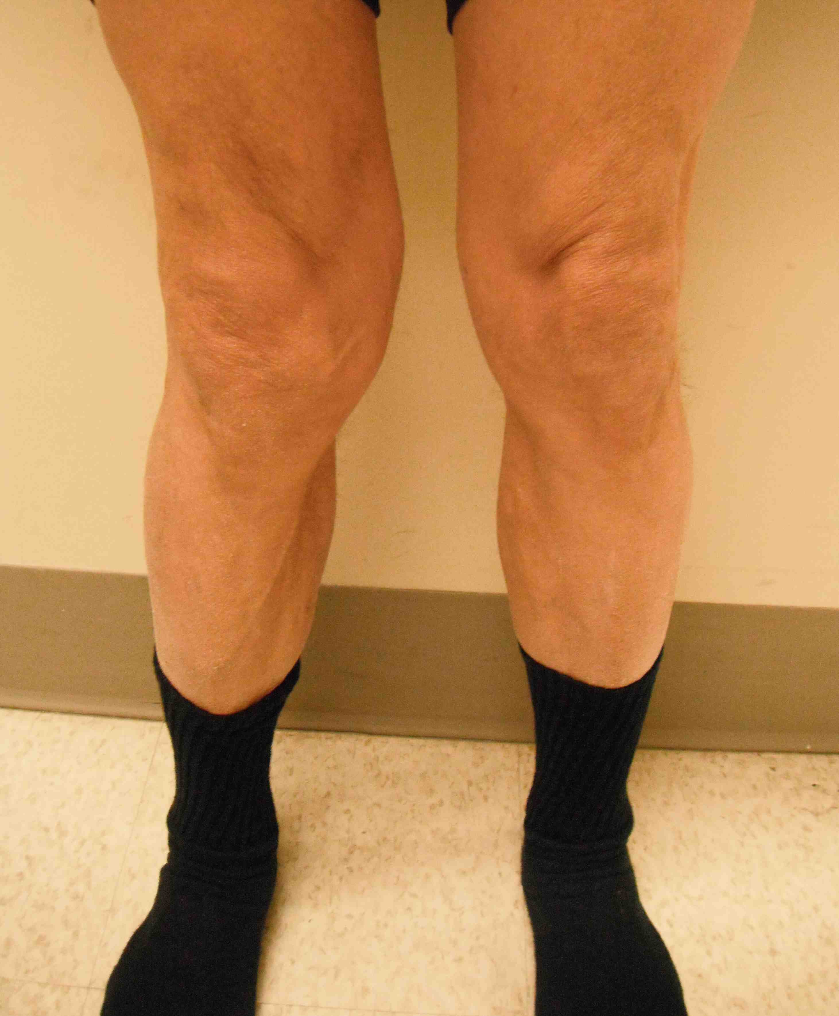 Valgus Malalignment